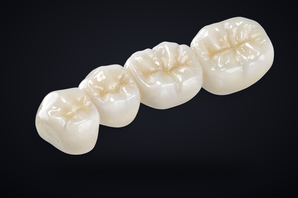 Posterior crown and bridge restoration