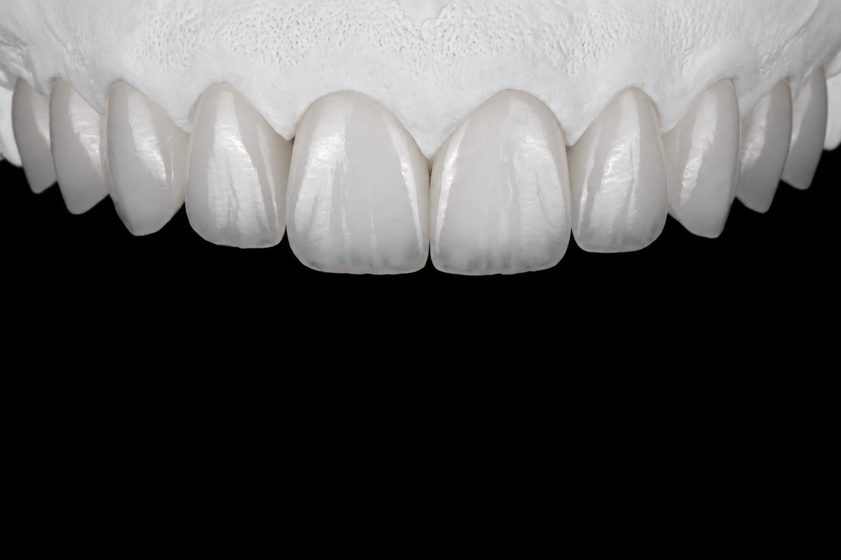 Anterior esthetics restoration