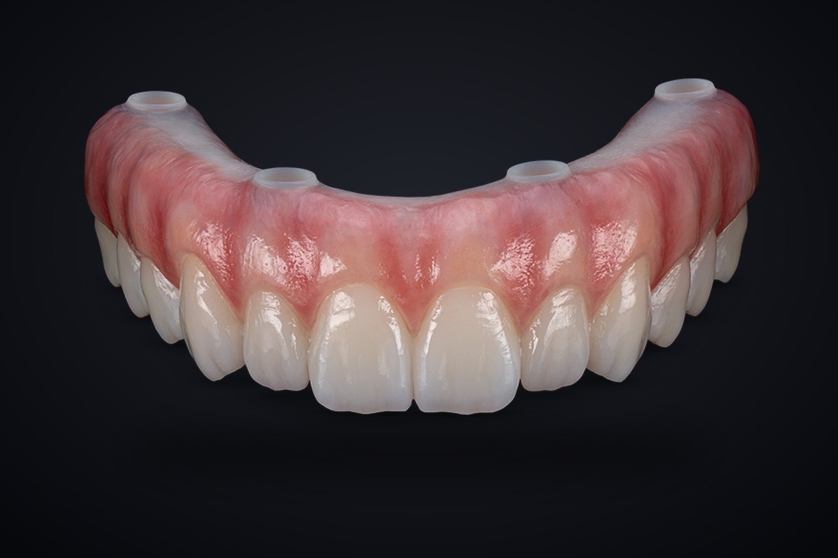 Full-Arch Restorations